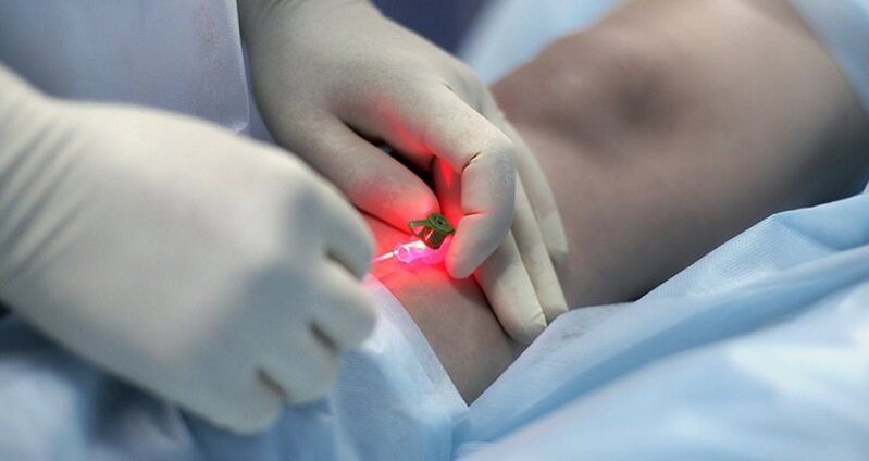 Хирургично лечение на разширени вени